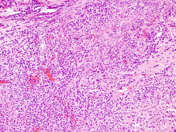 3B10 Abscess-Cerebritis (Case 3) H&E 10