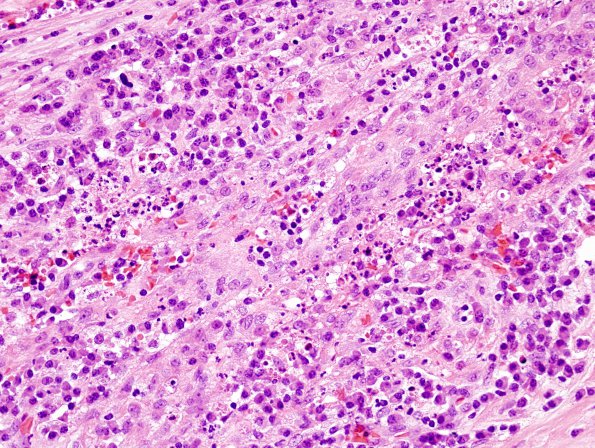 3B11 Abscess-Cerebritis (Case 3) H&E 11 (2)