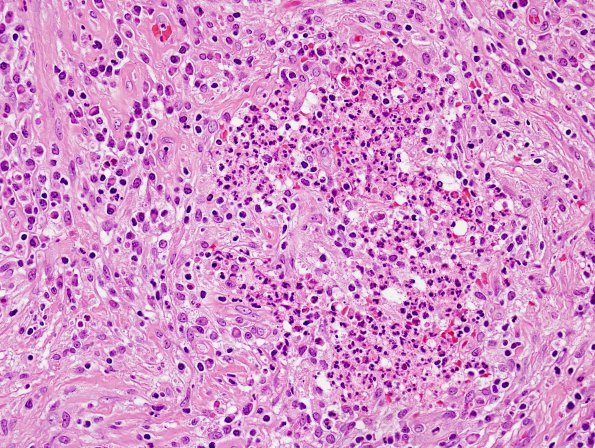 3B13 Abscess-Cerebritis (Case 3) H&E 8