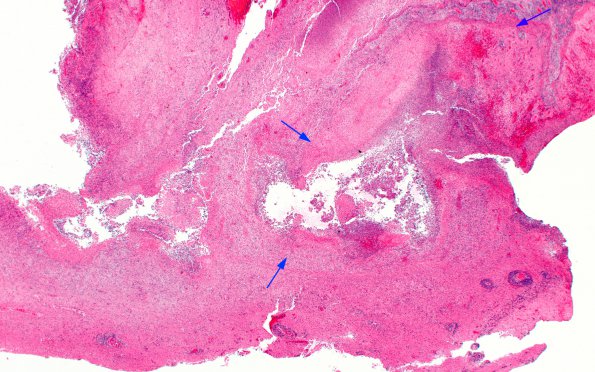 3B14 Abscess-Cerebritis (Case 3) H&E 14 copy copy