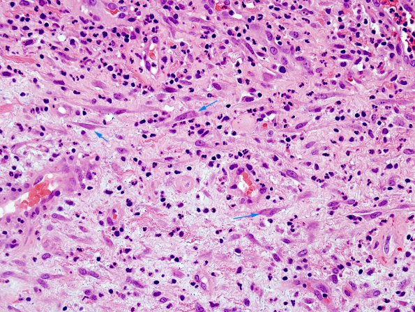 3B16 Abscess-Cerebritis (Case 3) H&E 5 copy