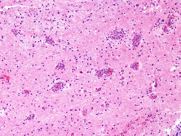 3B17 Abscess-Cerebritis (Case 3) H&E 3