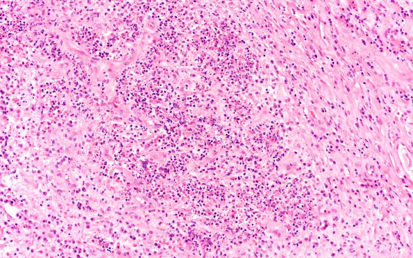 3B3 Abscess-Cerebritis (Case 3) H&E 20