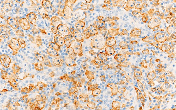 3B4 Abscess-Cerebritis (Case 3) CD163 40X