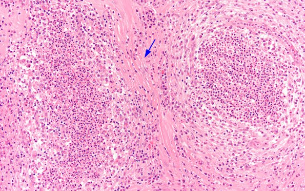 3B5 Abscess-Cerebritis (Case 3) H&E 18 copy