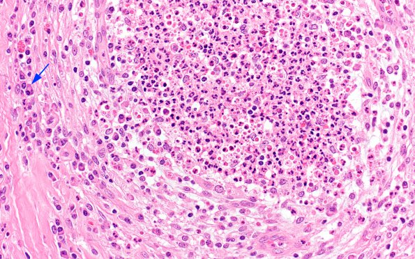 3B6 Abscess-Cerebritis (Case 3) H&E 19 copy