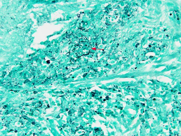 3B8 Abscess-Cerebritis (Case 3) GMS 1 copy A