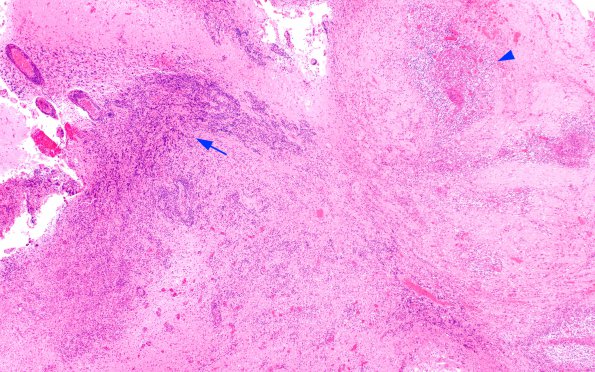 3B9 Abscess-Cerebritis (Case 3) H&E 1 copy