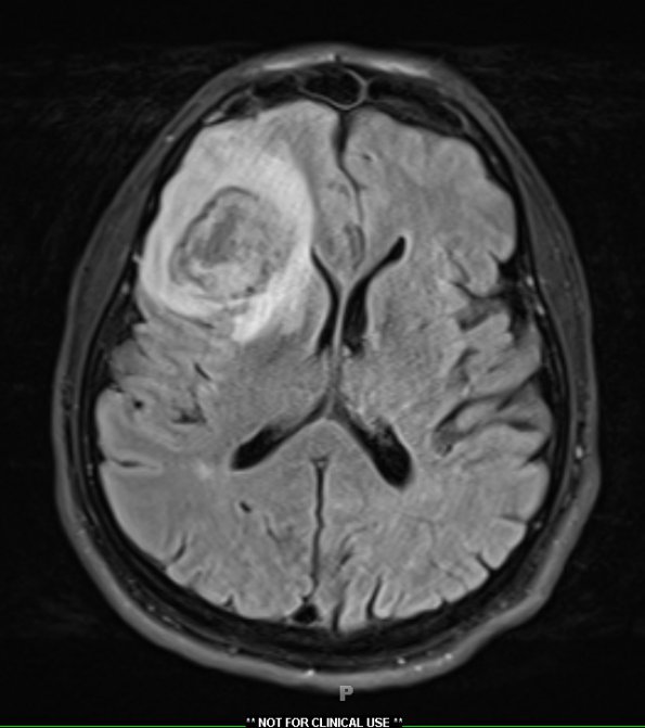4A1 Cerebritis (Case 4) FLAIR 1 - Copy