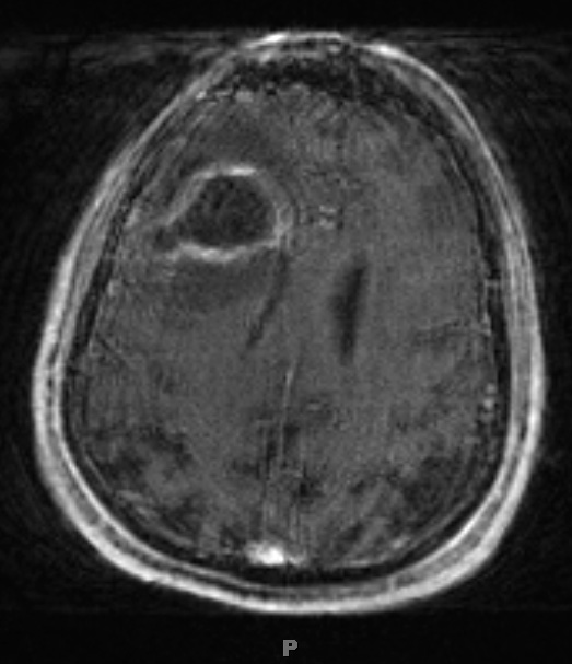 4A2 Cerebritis (Case 4) T1 with contrast 1 - Copy