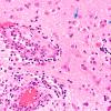 4B1 Cerebritis, incipient abscess (Case 4) H&E 5 copy