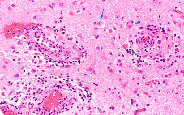 4B1 Cerebritis, incipient abscess (Case 4) H&E 5 copy