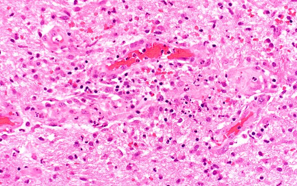 4B3 Cerebritis, incipient abscess (Case 4) H&E 3