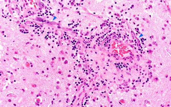 4B4 Cerebritis, incipient abscess (Case 4) H&E 6 copy