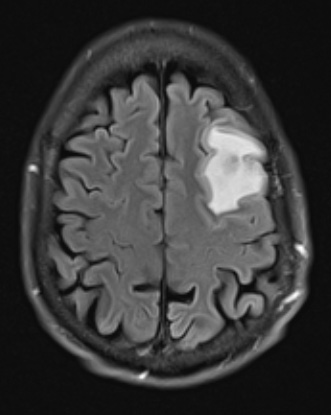 5A1 (Case 5) NP22-939 FLAIR - Copy