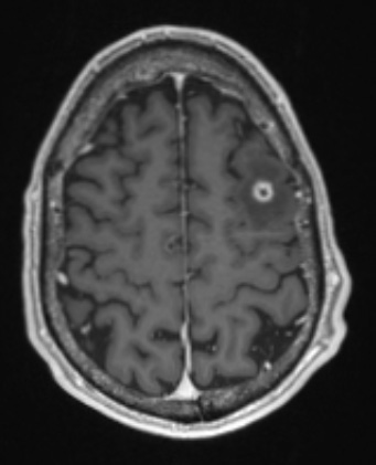 5A3 (Case 5)  T1W - Copy