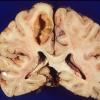 Abscess, Subacute - Chronic