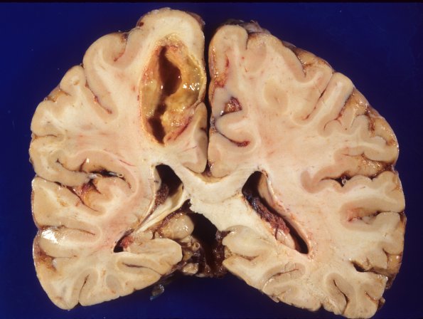 0B Abscess, bacterial 2a