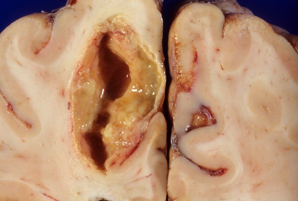 0C Abscess, bacterial 2b