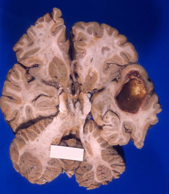 0D Abscess, chronic