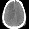 10A1 Abscess (Case 10) CT - Copy