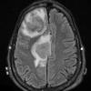 10A2 Abscess (Case 10) FLAIR - Copy