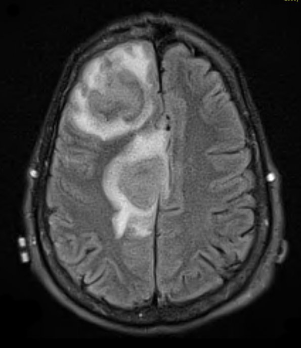 10A2 Abscess (Case 10) FLAIR - Copy