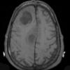 10A3 Abscess (Case 10) T1 (2) - Copy