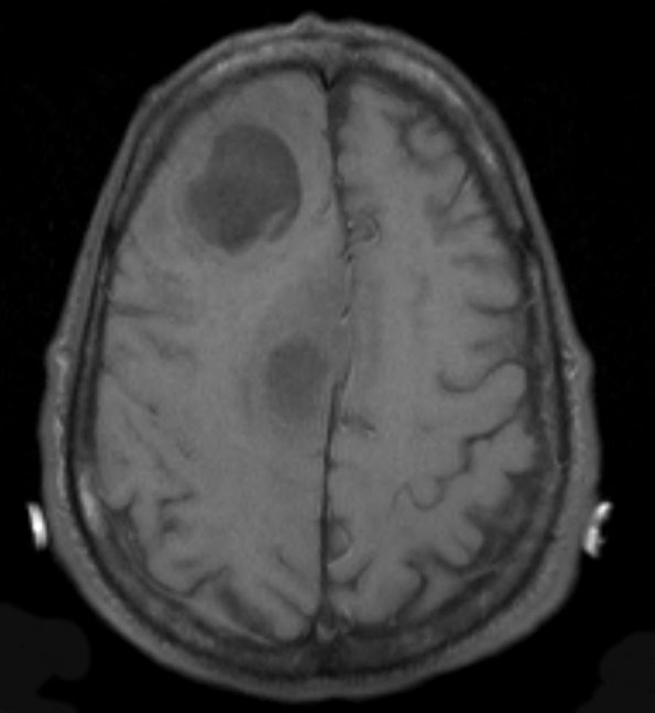 10A3 Abscess (Case 10) T1 (2) - Copy