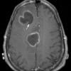 10A4 Abscess (Case 10) T1 W copy - Copy