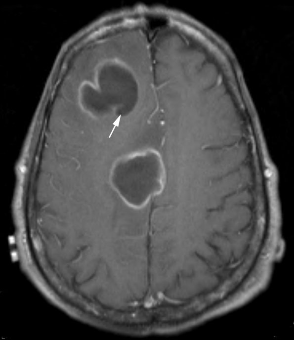 10A4 Abscess (Case 10) T1 W copy - Copy