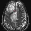 10A5 Abscess (Case 10) T2 BLADE W copy - Copy