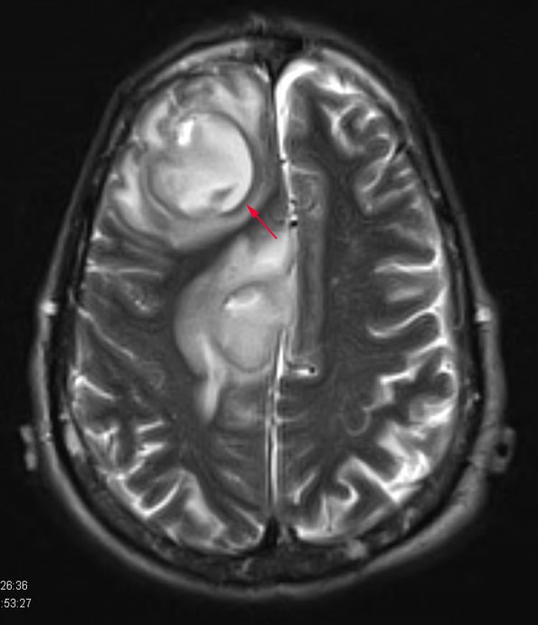 10A5 Abscess (Case 10) T2 BLADE W copy - Copy