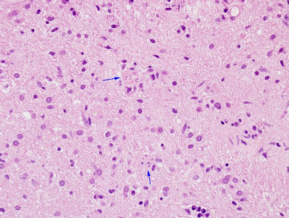 10B1 Abscess (Case 10) H&E (Creutzfeld cell) 1 copy