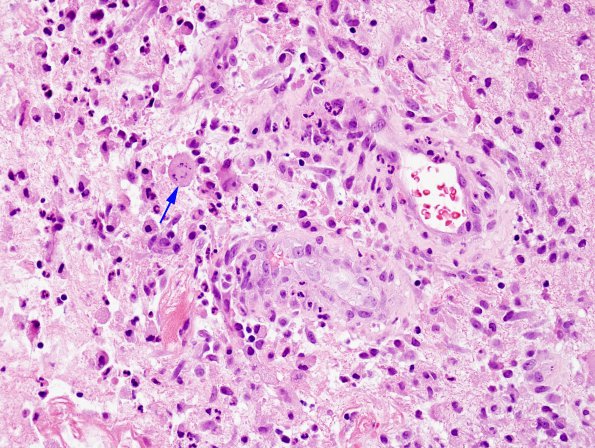 10B2 Abscess (Case 10) H&E (Creutzfeld cell) 2 copy