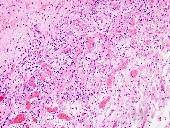 10B3 Abscess (Case 10) H&E 3