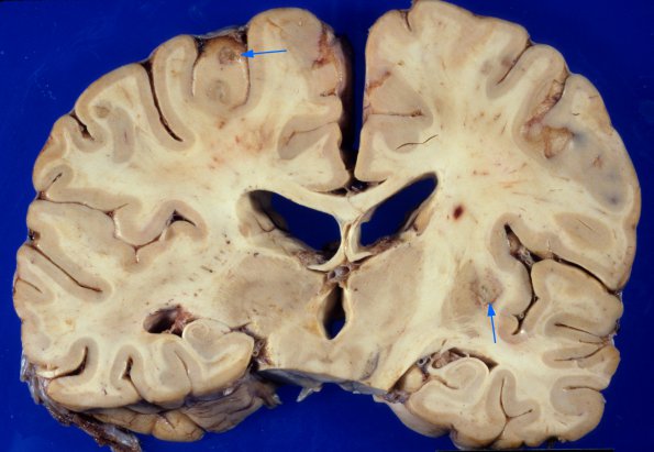 11A1 Abscesses, Nocardia (Case 11) A2 copy