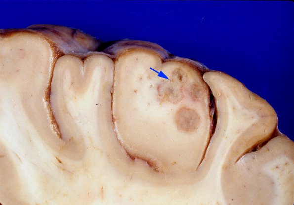 11A3 Abscesses, Nocardia (Case 11) 4 copy