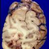 11A4 Abscesses, Nocardia (Case 11) A3