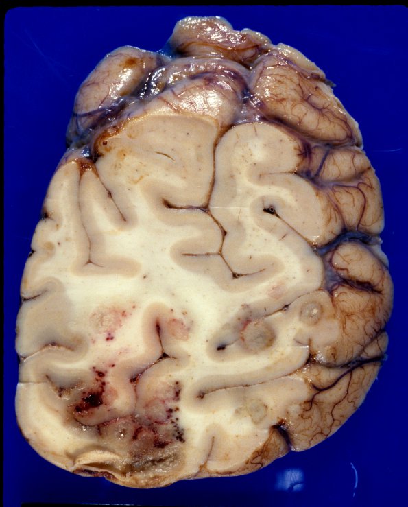 11A4 Abscesses, Nocardia (Case 11) A3