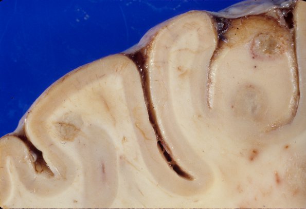 11A5 Abscesses, Nocardia (Case 11) A6