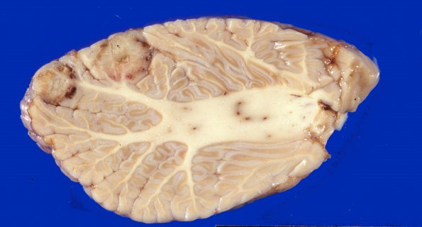 11A8 Abscesses, Nocardia (Case 11) 2