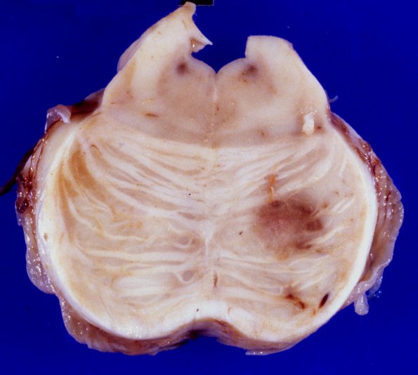 11A9 Abscesses, Nocardia (Case 11) 6