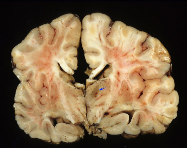 12A1 Abscess & Superior Sagittal Sinus Thromboplebitis (Case 12) 1 copy