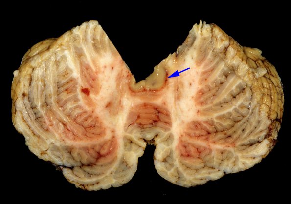 12A2 Abscess & Superior Sagittal Sinus Thromboplebitis (Case 12)