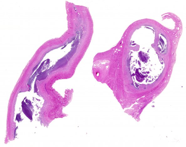 12B1 Abscess & Superior Sagittal SInus Thromboplebitis (Case 12) (2)