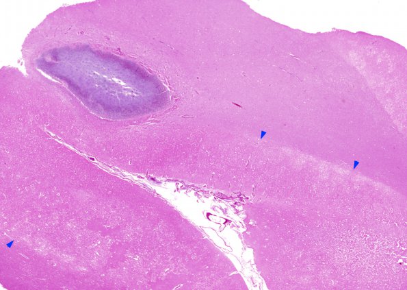 12B2 Abscess & Superior Sagittal SInus Thromboplebitis (Case 12) copy