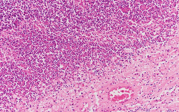 12B4 Abscess & Superior Sagittal Sinus Thromboplebitis (Case 12)