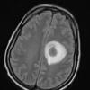 13A1 Abscess (Case 13) FLAIR 1 - Copy