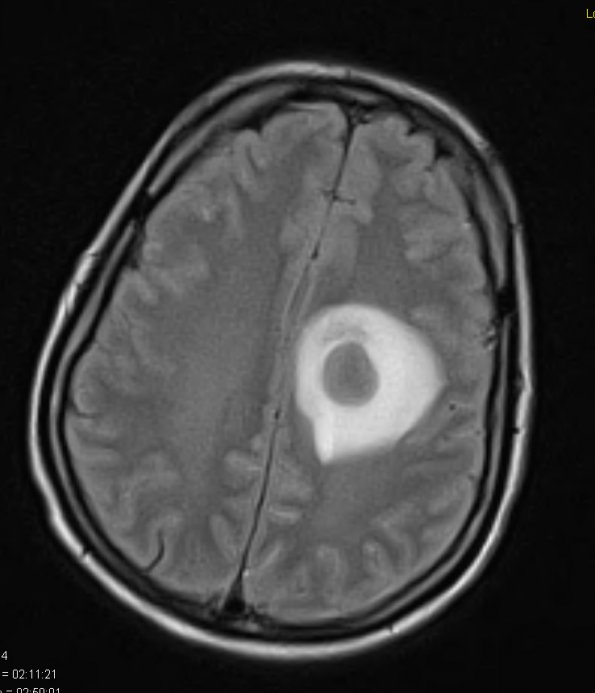 13A1 Abscess (Case 13) FLAIR 1 - Copy